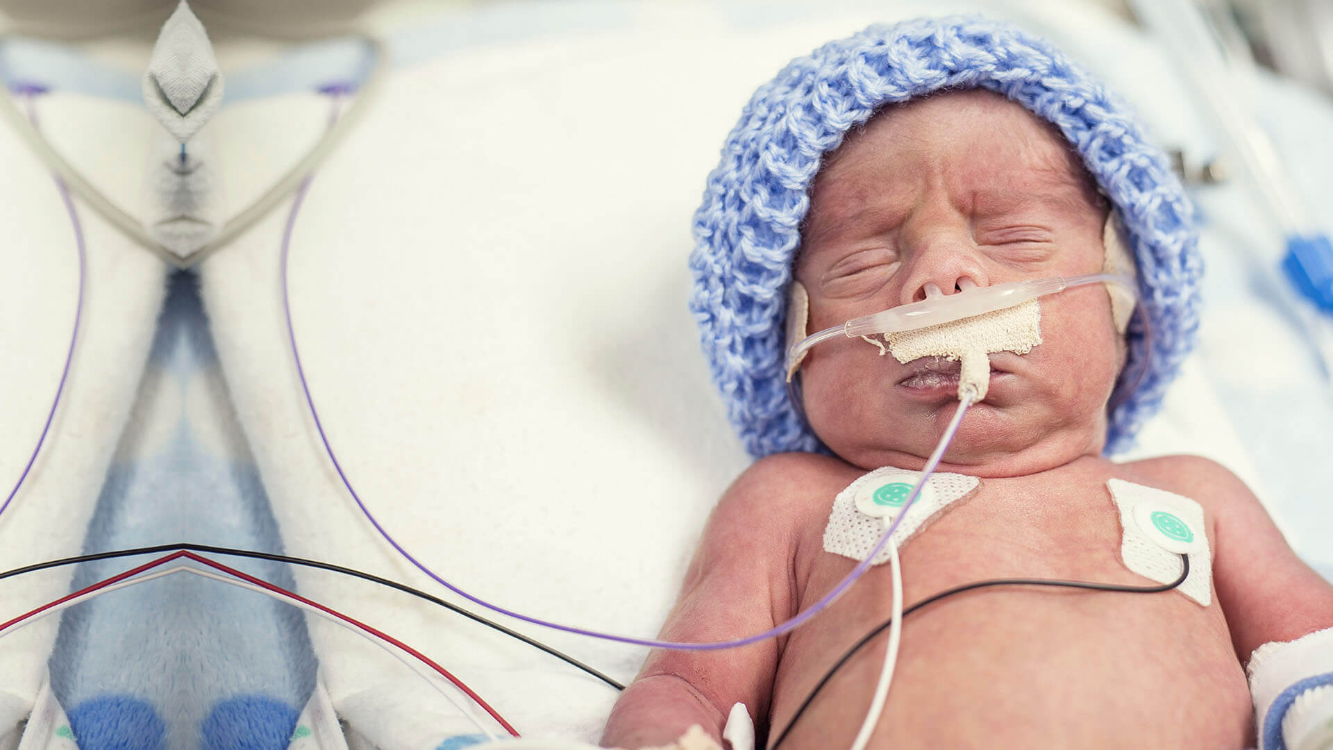 A newborn baby in the NICU with a breathing tube after a birth injury